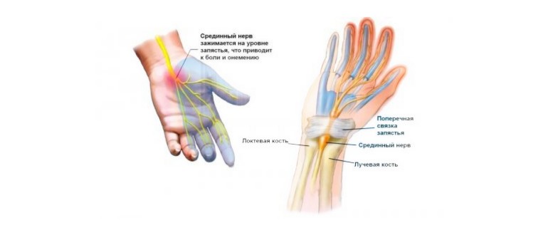 Защо малкият пръст на дясната ръка изтръпва: причини и възможности за лечение