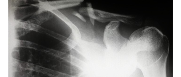 Счупването се диагностицира чрез рентгенова снимка, компютърна томография или ядрено-магнитен резонанс