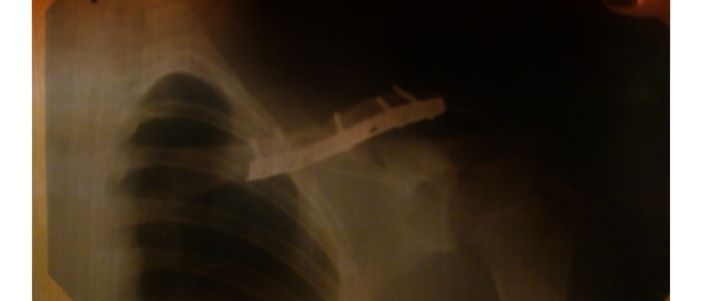 Рентгенова снимка на счупена ключица