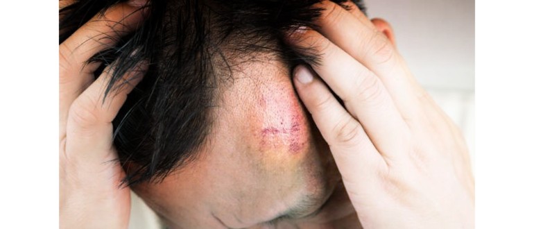Травмата на главата може да причини увреждане на мозъка