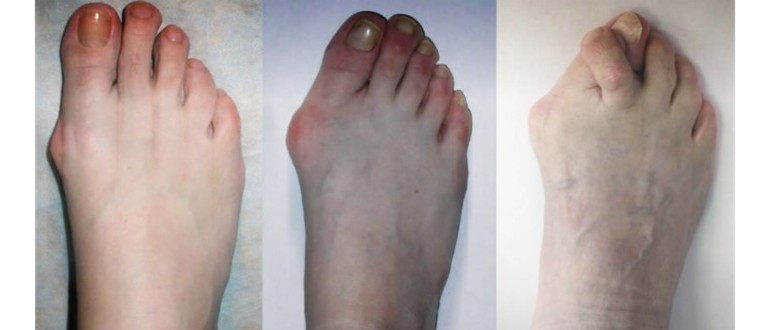 Степени на остеоартрит на пръстите на краката