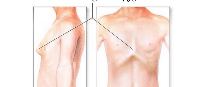 Как да възстановите гръдния кош и да коригирате гръдната кривина: ръководство