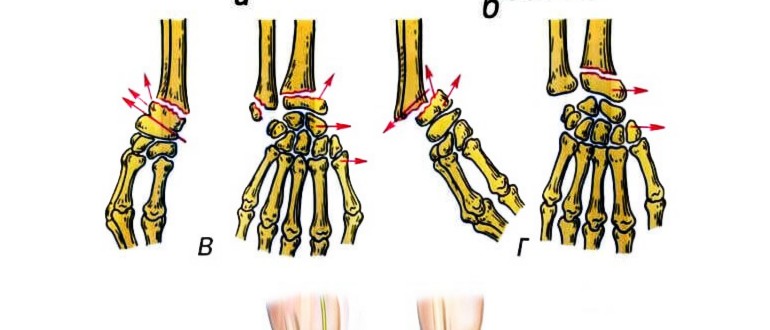 Как да развиете ръката след счупване на лъчевата кост у дома