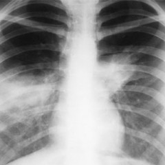 Рентгеново изследване с пневмония. Симптоми, признаци, описание на рентгеновите лъчи при пневмония.