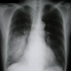 Рентгеново изследване с пневмония. Симптоми, признаци, описание на рентгеновите лъчи при пневмония.
