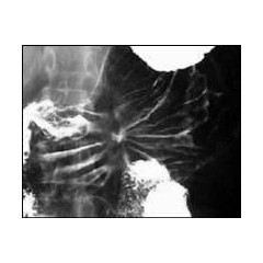 Рентгенови лъчи на стомаха. Как се прави изследването, как да се подготви, какво показва рентгеновото изследване на стомаха?