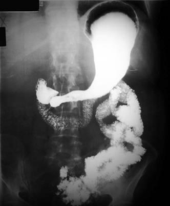 Рентгенови лъчи на стомаха. Как се прави изследването, как да се подготви, какво показва рентгеновото изследване на стомаха?