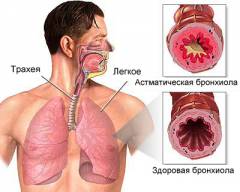 Сърдечна астма. Причини, симптоми, признаци, диагноза и лечение на патологията