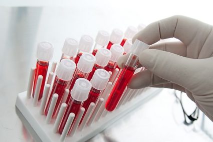 Какво представлява този кръвен тест за пикочната киселина и защо е необходимо?