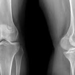 Рентген на здраво коляно съединение: снимка на коляното на снимката