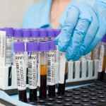 Кръвен тест за серомукоиди: нормални и повишени кръвни нива