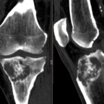 CT на коляното: изчислена томография на коляното