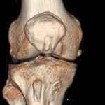 CT на коляното: изчислена томография на коляното