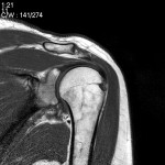 CT на раменната става: томография на рамото