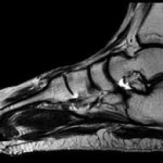 MRI на глезенните стави на краката: томография на глезенните стави