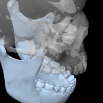 ЯМР на темпорамандибуларната става: томография на челюстната става