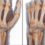 ЯМР на ръката и ръката: томография на китката