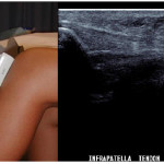Uzi коляно съединение: какво показва с артрит