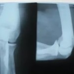 Рентгеново изображение на лакътната става: снимки на рентгеновите лъчи на лакътя