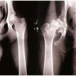 Рентгеново изображение на бедрената кост: норма в снимките на деца и възрастни