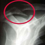 Рентгеново изследване на раменната става: снимка на рентген на рамото