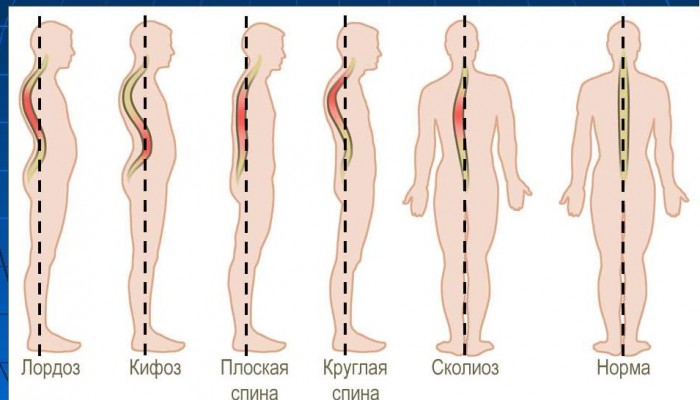 Какво представлява цервикалната и лумбалната лордоза на гръбначния стълб?