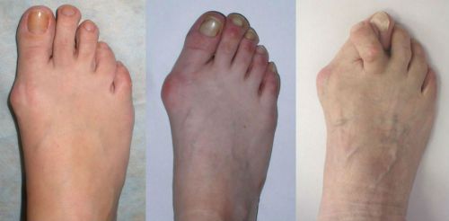 Болки в пръстите на крака - Неврома на Мортън | Ortos