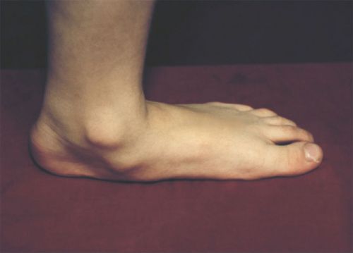 Анатомия на ставите на краката и техните заболявания