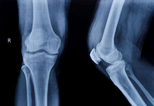 Структурата и заболяванията на колянния менискус