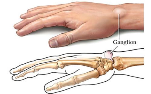 Анатомия на сухожилието на ръката