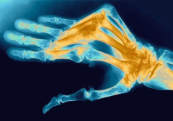 Артрит на ставите на пръстите: какви симптоми се проявява като как да се лекува