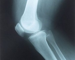 Артрит на колянната става (преследване): симптоми и признаци на това заболяване