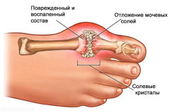 Подагра (подагрозен артрит): какви са симптомите и лечението
