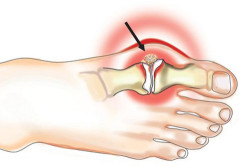 Подагра (подагрозен артрит): какви са симптомите и лечението