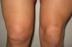 Синовитит на коляното: Причини, симптоми и лечение на това заболяване