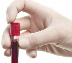 Увеличаване на пикочната киселина в кръвта: причини, симптоми, къде да преминат тестове