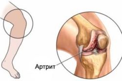 Малкият ревматоиден артрит: Причини, симптоми и лечение