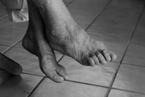 Как да се лекува остеоартроза на краката: съвет на лекар