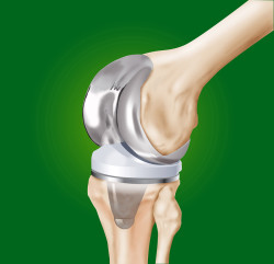 Операции на колянната става с артроза