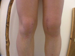 Остеоартрит на колянната става (гонартроза): симптоми и признаци