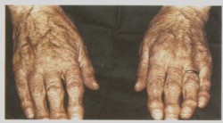 Разликата между артрита и артрозата: това, което е важно да си спомним пациента