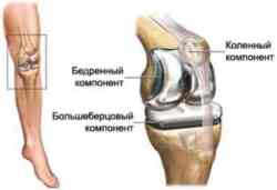 Ендопротезиката на колянната става: същността на операцията, нейната цена, рехабилитацията