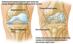 Остеоартрит на колянната става от 2-ра степен: причини, диагноза и лечение