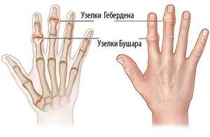 Артроза на пръстите: причини, симптоми, видове и методи на лечение
