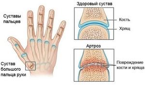 Артроза на пръстите: причини, симптоми, видове и методи на лечение