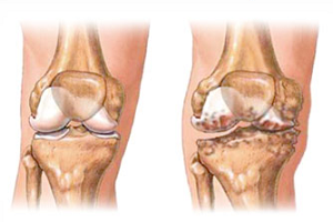 Деформиране на артрозата на колянната става - степен на заболяване и народни методи на лечение