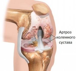 Остеоартрит на колянната става (гонартроза) 2 градуса: симптоми и лечение