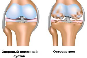 Мазилка за артроза на колянната става - ефективност на приложението и препоръки за употреба