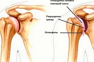 Защо може да се развие артроза на рамото и дали неговото възникване може да бъде предотвратено