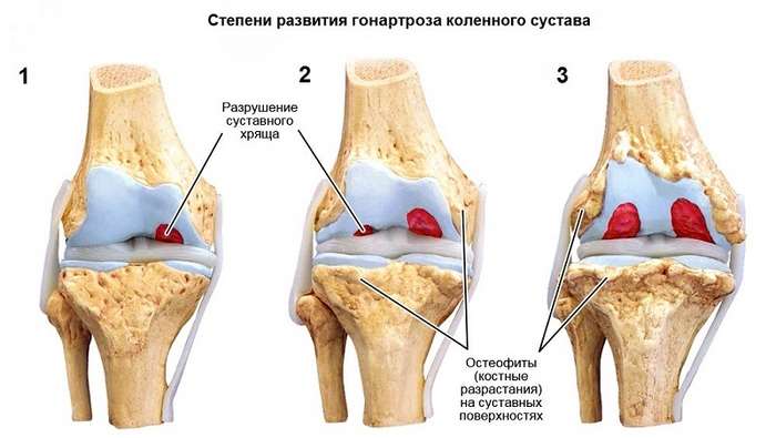 Гонартроза на колянната става от 2-ра степен: лечение с ефективни методи